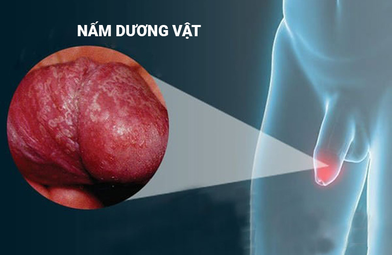 Nấm dương vật là tình trạng khá phổ biến