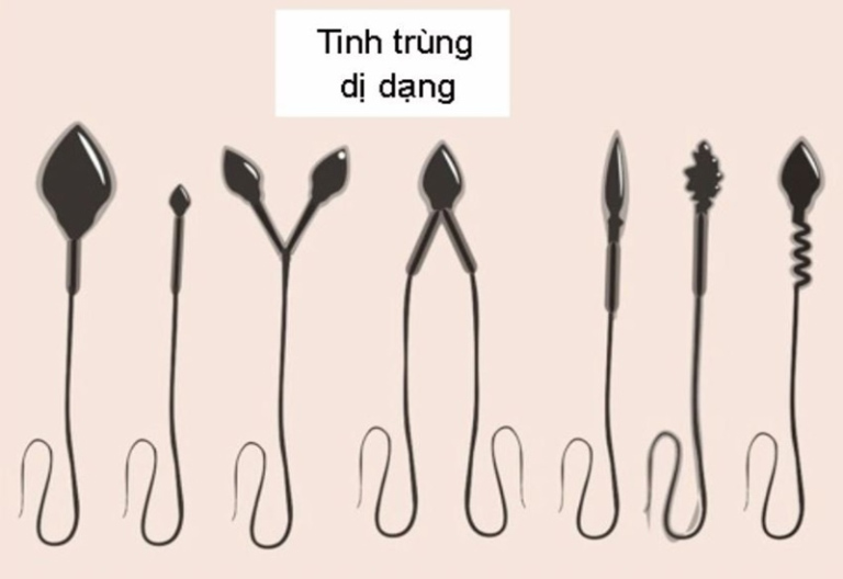 Tinh trùng dị dạng là khi tinh trùng có cấu trúc bất thường so với tiêu chuẩn bình thường