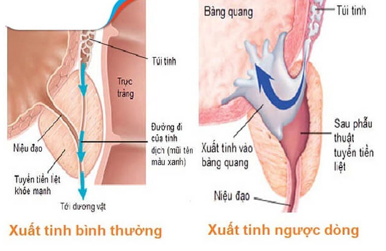 Nam giới bị xuất tinh ngược dòng