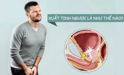 Xuất Tinh Ngược Dòng: Dấu Hiệu, Chẩn Đoán Và Cách Điều Trị