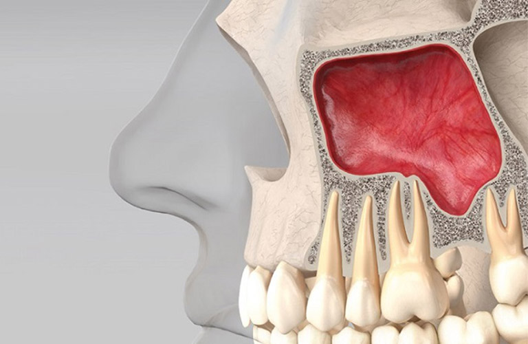 Viêm xoang hàm là bệnh lý khá phổ biến và nguy hiểm